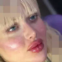 تخلیه غبغب .بکینی .باسن .صورت.