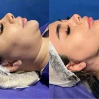 ساکشن و سوپر کانتورینگ غبغب دائمی(تکنیک v line)