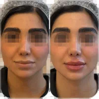 بوتاکس پیشانی و خط اخم - دکتر مریم هلاکو