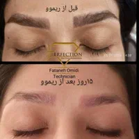 ریمووتخصصی وتضمینی ابرو،چشم،لب