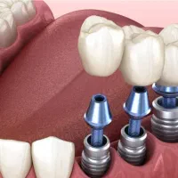 ایمپلنت فقط با هزینه مواد