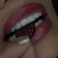 دندانپزشکیVIPلمینت/کامپوزیت/ایمپلنت/گارانتی واقعی