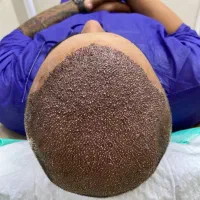 کاشت مو فقط با پرداخت ۱۰ میلیون|خدمات آرایشگری و زیبایی|تهران, جردن|دیوار