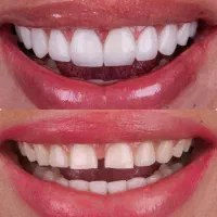 آفرویژه 2 روزه وباور نکردنی دندان/اقساط/قیمت قبل