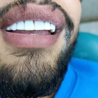 دندانپزشکی.دندانسازی کامپوزیت. با تخفیف ویژه