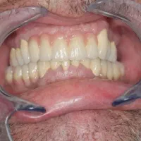 قسطی ایمپلنت و تمام خدمات دندانپزشکی بدون پیش|خدمات آرایشگری و زیبایی|اصفهان, دشتستان|دیوار