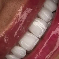 ایمپلنت/لمینیت/پروتز/اقساط بدون سود و پیش پرداخت