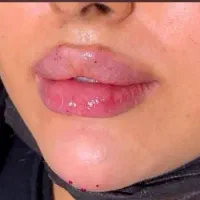 خدمات ژل و بوتاکس