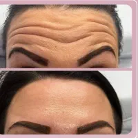 تزریق ژل و بوتاکس در کلینیک لیزر میراژ