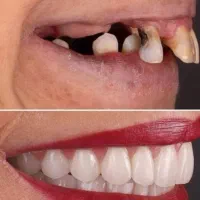 دندانپزشکی،ایمپلنت، اوردنچر|خدمات آرایشگری و زیبایی|مرند, |دیوار