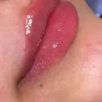 ژل و بوتاکس حرفه ای(حتی پنچشنبه)