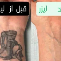 پاک کردن تتو با پیشرفته ترین لیزر کیوسوئیچ