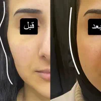 تزریق فیلر و بوتاکس اقساط توسط پزشک در مطب|خدمات آرایشگری و زیبایی|خرمشهر, |دیوار