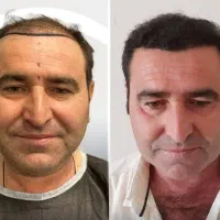 جشنواره پاییزه کاشت مو و کاشت ابرو|خدمات آرایشگری و زیبایی|تهران, دردشت|دیوار