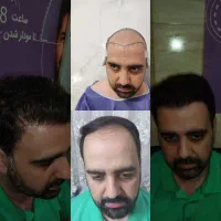 کاشت مو، ابرو کاشت تخصصی حرفه ای ریش فقط ۱۵ میلیون
