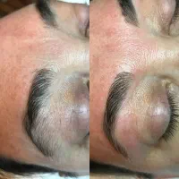 الکترولیز موهای زائد (سفید ،کرکی،ضخیم مشکی)