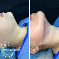 ساکشن غبغب ( تخصصی V لاین )