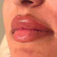 خدمات ژل فیلر بوتاکس|خدمات آرایشگری و زیبایی|هشتگرد, هشتگرد قدیم|دیوار