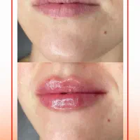 تزریق فیلر و جوانساز های صورت با تخفیف 50%