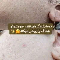 درماپلنینگ تخصصی صورت