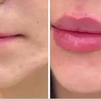 آموزش ژل بوتاکس لیفت نخ پی ارپی چربی