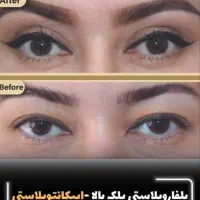 کاشت مو و ابرو/بوتاکس/بلفاروپلاستی/رفع غبغب/اقساطی|خدمات آرایشگری و زیبایی|تهران, سعادت‌آباد|دیوار