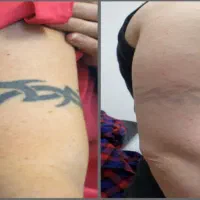 پاک کردن تتو با کیوسوییچ