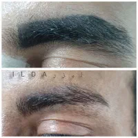 حذف تاتو و خالکوبی با لیزر کیوسوئیچ