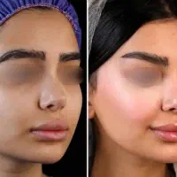 تزریق ژل وبوتاکس ۷۹۰. مید فیس ۴۵۰۰توسط پزشک مجرب