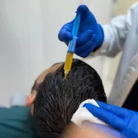 پی ارپی،مزو تراپی مو و صورت