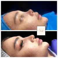 جراحی بینی بدون بیهوشی فقط ۱۹