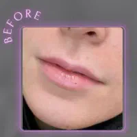 ژل و بوتاکس|خدمات آرایشگری و زیبایی|تهران, قلهک|دیوار