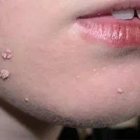 مشاوره خال و زگیل