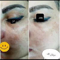 پاکسازی،فیشیال تخصصی،درمان مشکلات پوستی(تخفیف)|خدمات آرایشگری و زیبایی|گرگان, |دیوار