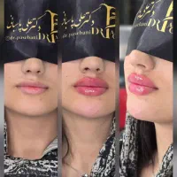 تزریق ژل وبوتاکس و لیزر موی زایدولیزر پاک کردن تتو