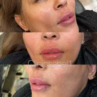 آموزش صفر تا صد فیلر و بوتاکس