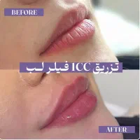 لیفت جراحی بینی بلفارو ژل لب بوتاکس مزو فشیال|خدمات آرایشگری و زیبایی|شاهین‌شهر, طالقانی|دیوار