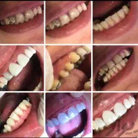 دندان مصنوعی با کیفیت و تخصصی در همدان با بیمه|خدمات آرایشگری و زیبایی|همدان, |دیوار