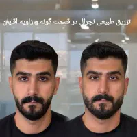 ژل و بوتاکس تخصصی مناسب آقایان و خانم ها