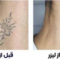 پاک کردن تتو جلسه ای ۷۰۰ با بهترین دستگاه