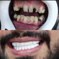 روکش دندان زیرکونیا ٪50 درصد تخفیف