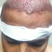 کاشت تخصصی مو ،ابرو ،مژه
