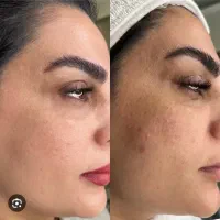 مزو ضد لک صورت و رفع جوش و اسکار و چربی سوز غبغب