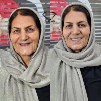 دست دندان مصنوعی