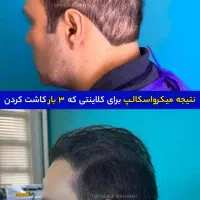 رفع کمپشتی مو با تکنیک میکرو اسکالپ /مکمل کاشتمو|خدمات آرایشگری و زیبایی|مشهد, احمدآباد|دیوار