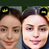 ثپل شو بدون عوارض