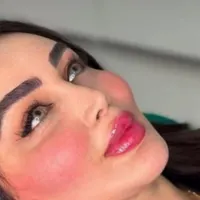 تزریق ژل فیلر لب،گونه،چانه،زاویه،بینی|خدمات آرایشگری و زیبایی|رشت, رشتیان|دیوار