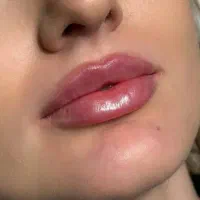 فیلرژل لب بوتاکس فیلر مادلینگ لیزرموهای زائدفشیال|خدمات زیبایی و سلامت|تهران, نیروی هوایی (پیروزی)|دیوار