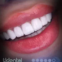 ایمپلنت لمینت کامپوزیت اقساط ویژه