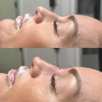 ژل بوتاکس آنزیم مزوتراپی پرسینگ فشیال فیلر|خدمات آرایشگری و زیبایی|مشهد, صیاد شیرازی|دیوار